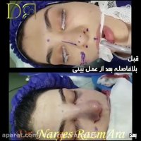 جراحی بینی بلافاصله پس از عمل