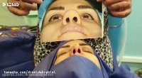عمل بینی گوشتی پهن توسط بهترین جراح بینی گوشتی تهران دکتر امید ابراهیمی