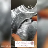 فیلم هیستروسونوگرافی