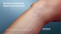 Treatment for Varicose Veins | Nucleus Health
