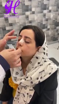 چسب زدن روی بینی