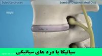 سیاتیکا یا درد های سیاتیکی