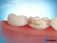 دکتر مسعود داودیان :: لق شدن بند ارتودنسی