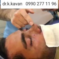 عمل بینی توسط دکتر کاوان