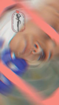 تزریق ژل لب دکتر فرشته جلالپور