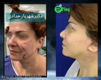 جراحی لیفت صورت و گردن