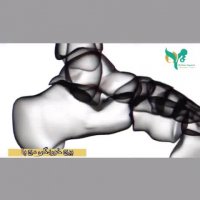 فیلمی کوتاه از مچ پای پیچ خورده