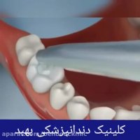 پرکردن دندان