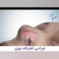 جراحی انحراف بینی