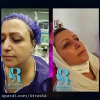 فیلم قبل و بعد از عمل بینی مراجعه کننده عزیزمون