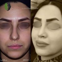 شش ماه بعد از جراحی زیبایی بینی | دکتر باستانی نژاد