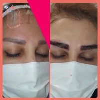 فیلم قبل و بعد از کاشت ابرو دکتر فرشته جلالپور