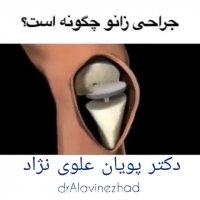 جراحی زانو چگونه است؟
