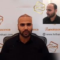 کاشت مو رنسانس- سوپر کاشت کلینیک تخصصی رنسانس