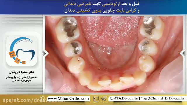 قبل و بعد ارتودنسی بدون کشیدن دندان | دکتر مسعود داوودیان