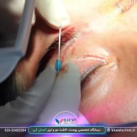 کاشت ابرو - 02632402304