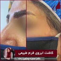 فیلم نمونه واقعی کاشت ابروی طبیعی