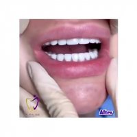 اصلاح بهم ریختگی دندان و طرح لبخند