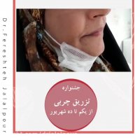 جشنواره تخفیف تزریق چربی دکتر فرشته جلالپور