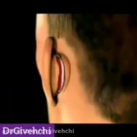 روند جراحی زیبایی گوش