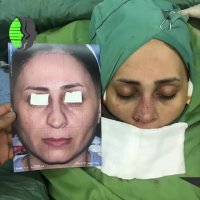نتیجه جراحی زیبایی بینی