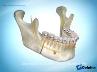 جراحی جلو آوردن فک پایین | دکتر مسعود داوودیان