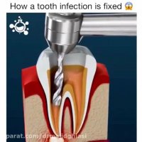 درمان ریشه-عصب کشی دندان -دکترمجید قیاسی دندانپزشک زیبایی مشهد