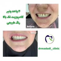 4 واحد ونیر کامپوزیت فک بالا به رنگ طبیعی