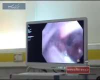 ابداع روش درمان کیست های ریه بدون جراحی