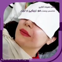 تزریق ژل خط خنده