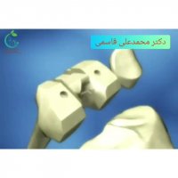 تعویض مفصل زانو