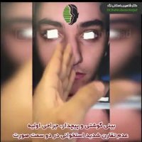 جراحی زیبایی بینی گوشتی