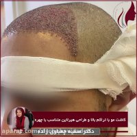 فیلم واقعی کاشت مو با تراکم بالا و طراحی هیر لاین متناسب با چهره