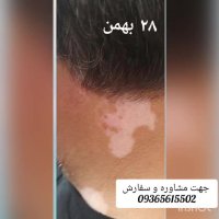 درمان گیاهی پیسی