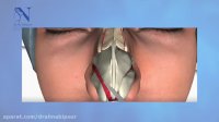 فیلم انیمیشن جراحی زیبایی بینی