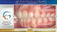 قبل و بعد ارتودنسی | دکتر مسعود داوودیان، متخصص ارتودنسی