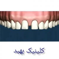 افزایش طول تاج دندان