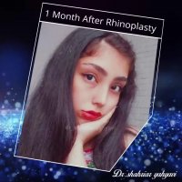 یک ماه بعد از جراحی بینی | دکتر شهریار یحیوی