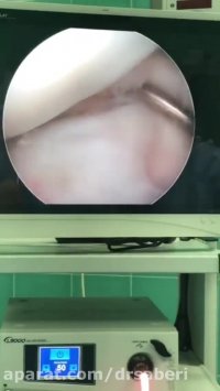 فیلم جراحی رباط صلیبی