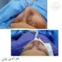 بلافاصله پس از جراحی بینی