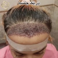 کاشت مو بانوان