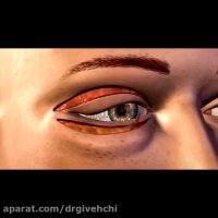 مراحل جراحی زیبایی پلک