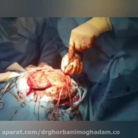 جراحی کرانیوپلاستی