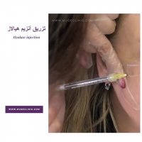 تزریق آنزیم هیالورونید