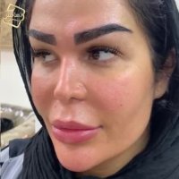 کاشت ابرو تخصصی