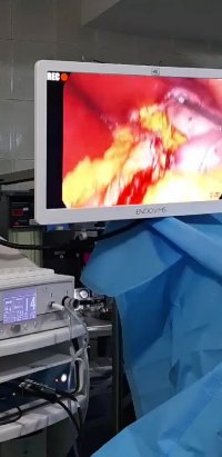 لایو اینستاگرام : جراحی چاقی اسلیوکاسترکتومی در خانم 31 ساله