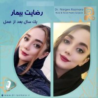 رضایت بیمار پس از یکسال از عمل بینی