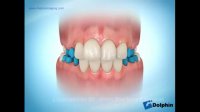 دکتر مسعود داودیان :: پلاک متحرک ارتودنسی برای افزایش عرض قوس دندانی
