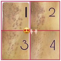 زگیل تناسلی درمان شد حتما ببینید