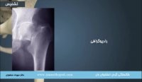 شکستگی گردن فمور در ناحیه لگن